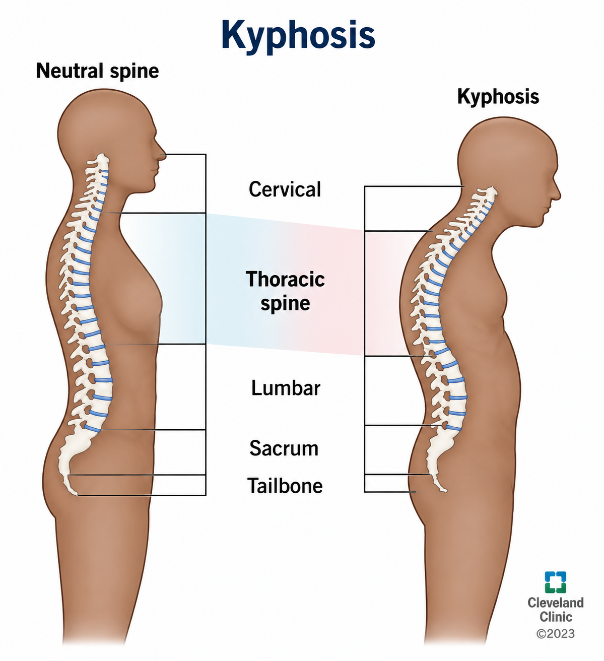 Kyphosis Overview