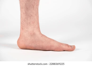 Flat Feet Overview