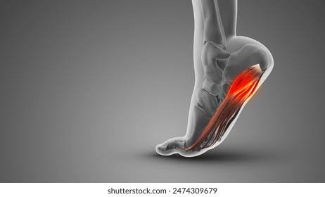 Morton's Foot Overview