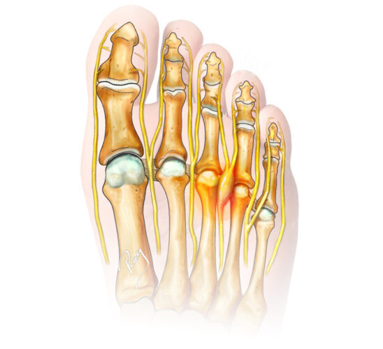 Morton's Neuroma Overview