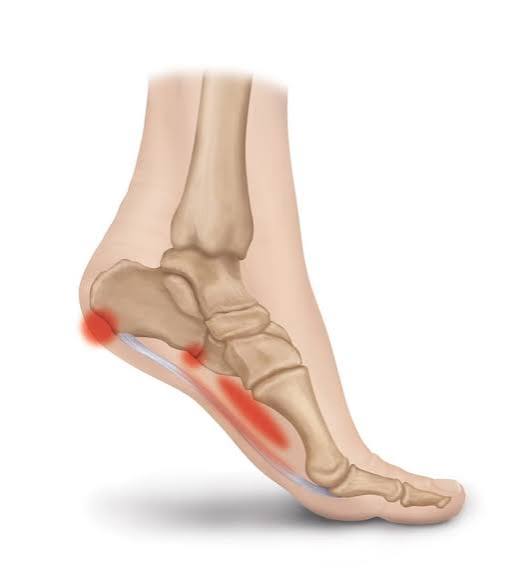 Plantar Fasciitis Overview