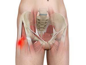 Adductor Tendinitis Overview
