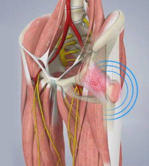 Snapping Hip Syndrome Overview