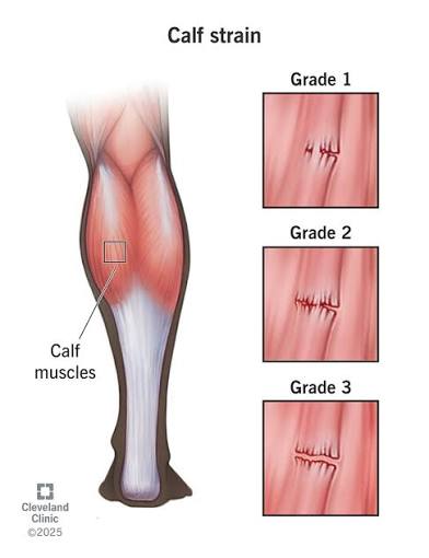 Calf Strain Overview