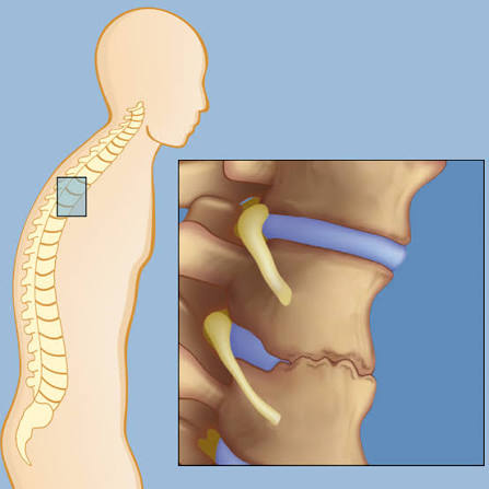 Ankylosing Spondylitis Overview