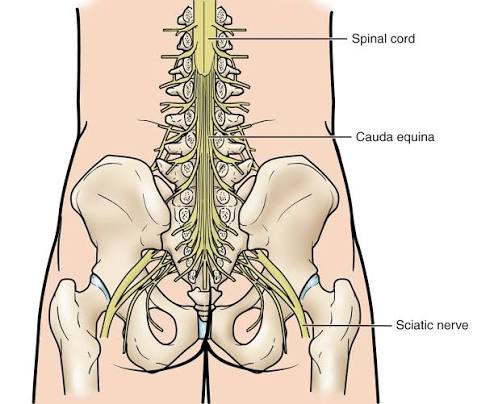 Cauda Equina Syndrome Overview