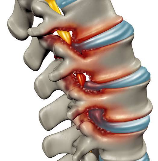 Lumbar Canal Stenosis Overview