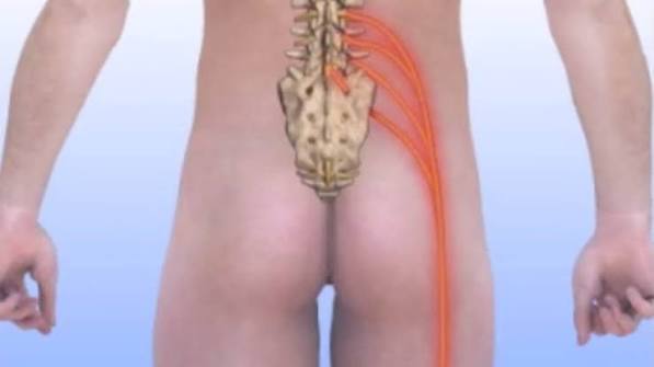 Sciatica Overview