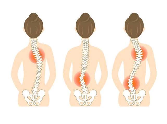 Scoliosis Overview